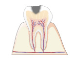 Ｃ１｜エナメル質のむし歯