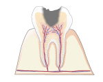 Ｃ３｜歯髄のむし歯